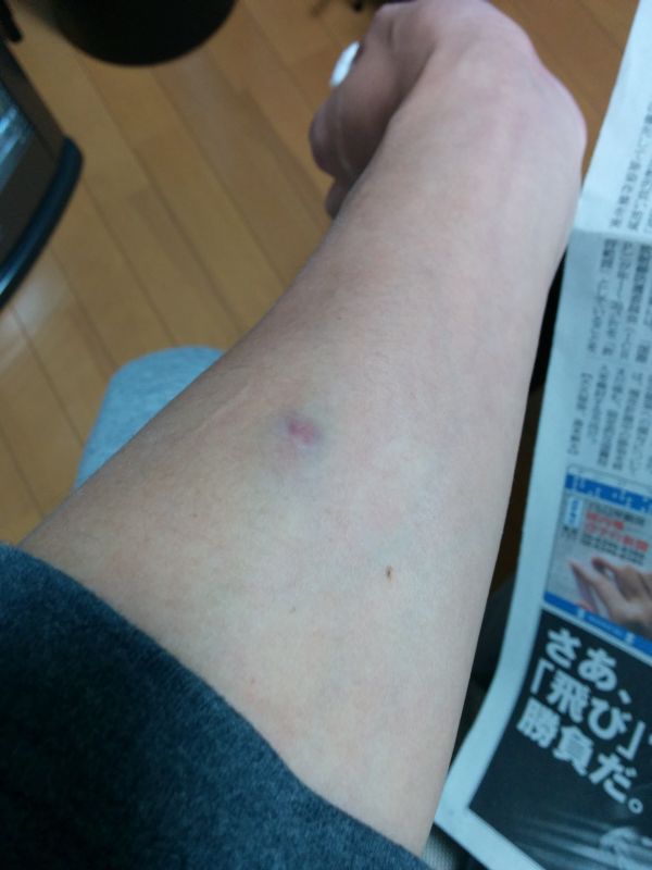 針の跡