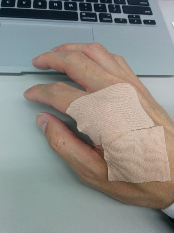 右人差し指の関節炎